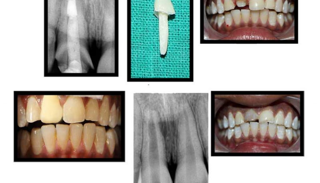 CASE-WITH-ROOT-CANAL-TREATMENT-WITH-COMPOSITE-POST