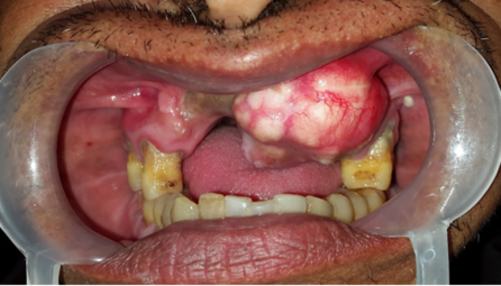 rare case of Chondroblastic Osteosarcoma