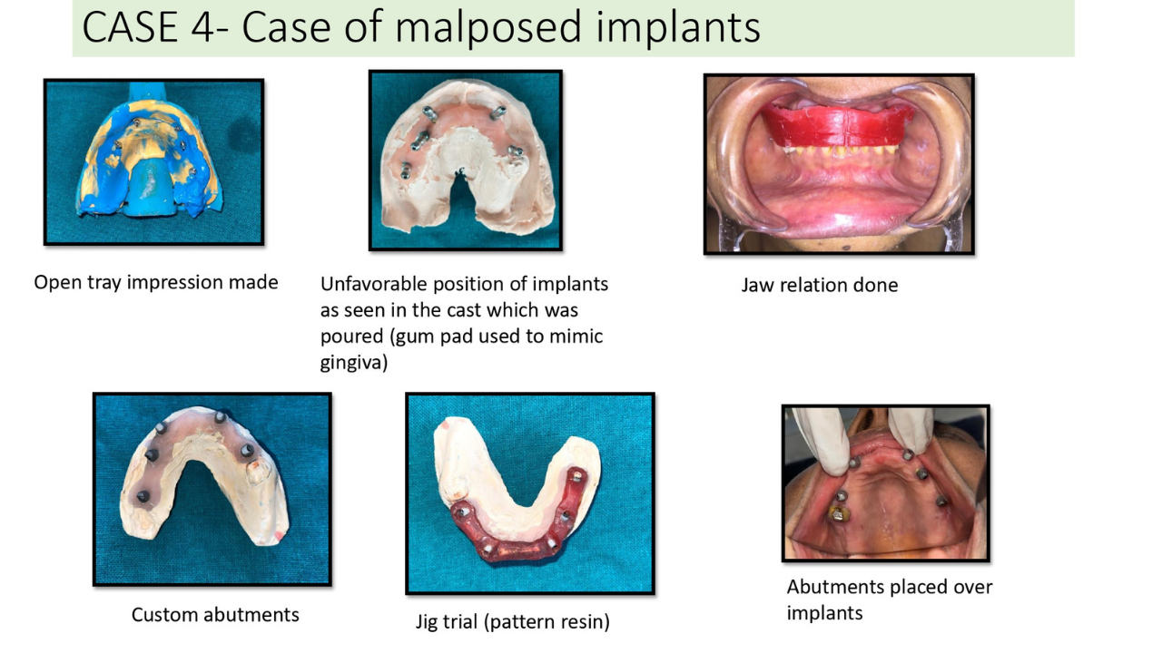 Case of malposed implants
