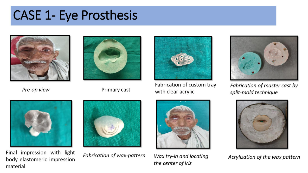 Eye Prosthesis