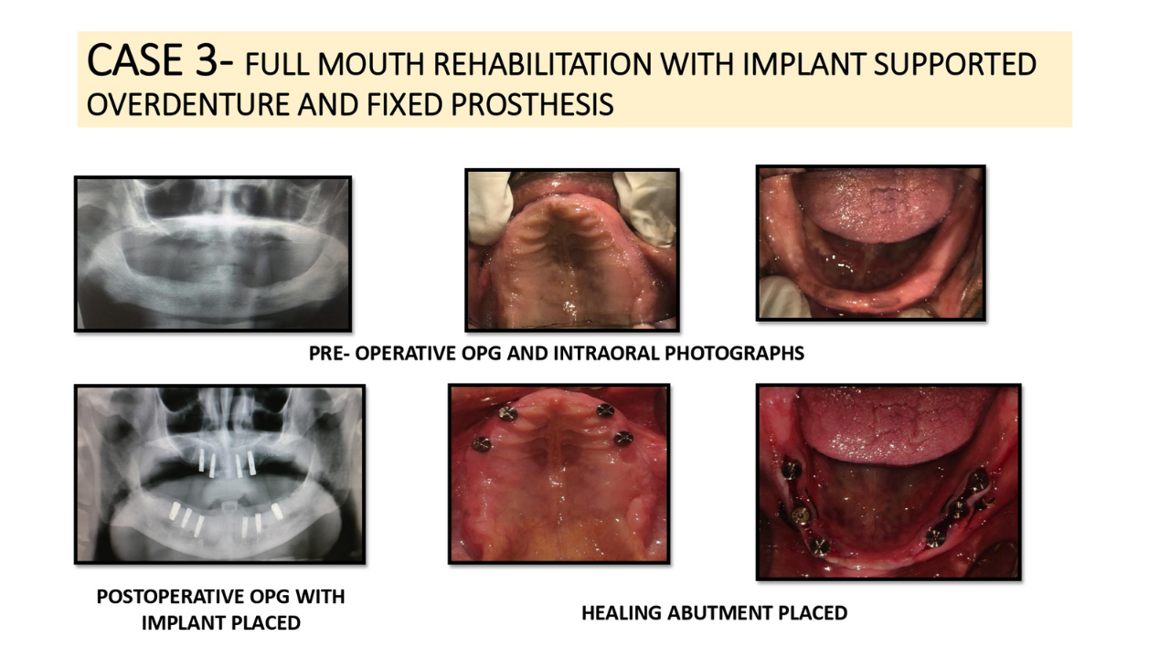 FULL MOUTH REHABILITATION WITH IMPLANT SUPPORTED OVERDENTURE AND FIXED PROSTHESIS