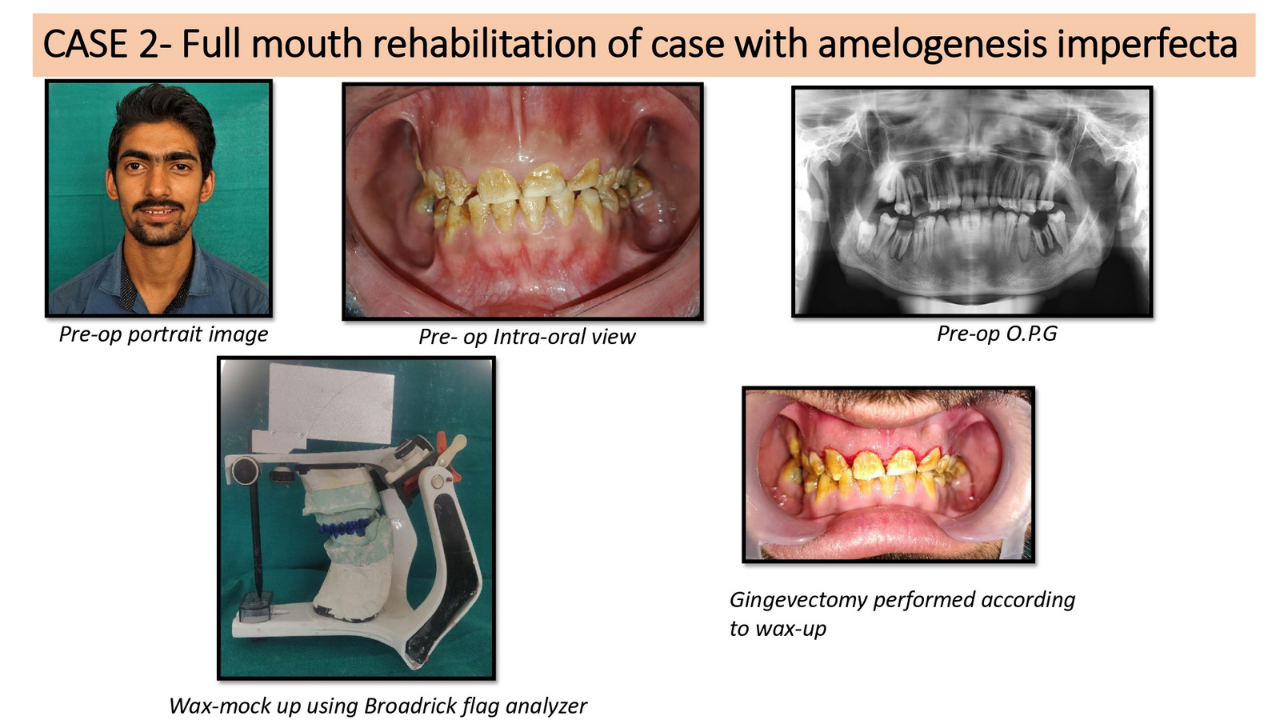 Full mouth rehabilitation of case with amelogenesis imperfecta