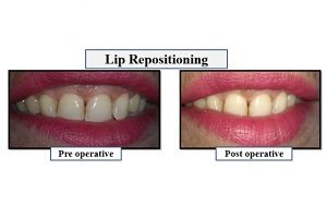surgical procedures -lip repositioning