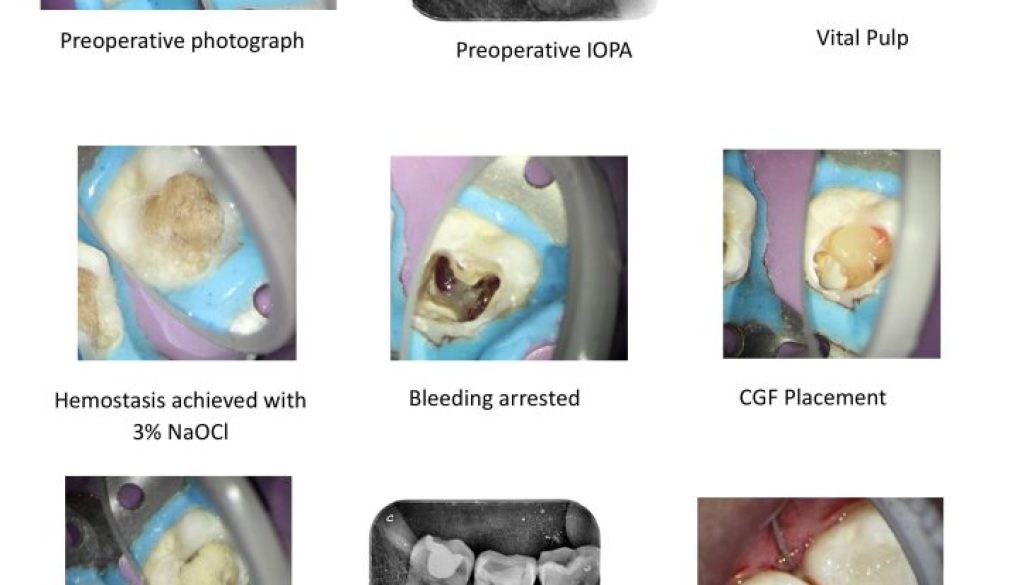 CGF Pulpotomy